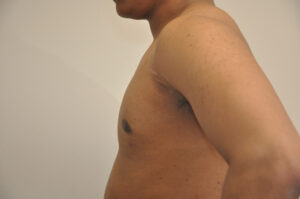 A person’s bare upper torso and arm, viewed from the side against a plain background.