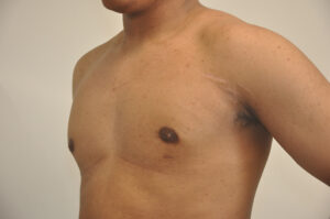 A person’s bare chest and upper torso, with a faint scar visible near the right armpit against a plain background.