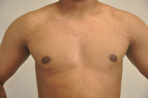 A person's bare chest and shoulders showing faint scars below the nipples and minor scattered blemishes on the skin.