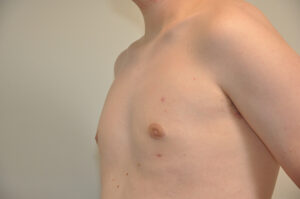 A shirtless person shown from the shoulders to the abdomen, facing sideways, with some small blemishes visible on the chest and light skin.