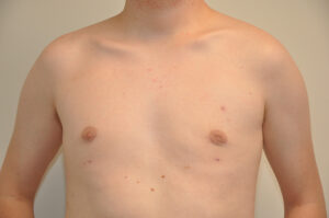 A shirtless person with fair skin and scattered small red spots and moles visible on the chest and upper arms, standing against a plain background.