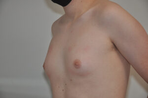 A person with a bare chest and visible breast tissue stands against a plain background, wearing a black face mask.