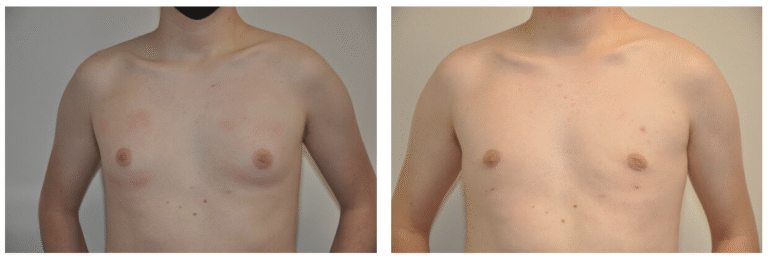 Two side-by-side photos of a male patient’s torso, shirtless, with some red patches in the left image and clearer skin after male breast reduction in the right image.