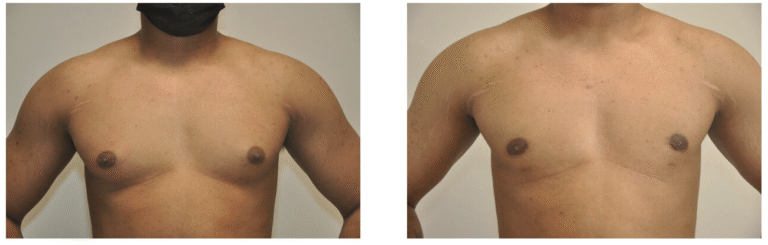 Two side-by-side photos show patient 9's bare chest before (left) and after (right) a male breast reduction, with visible reduction in breast tissue and improved chest contour in the after image.