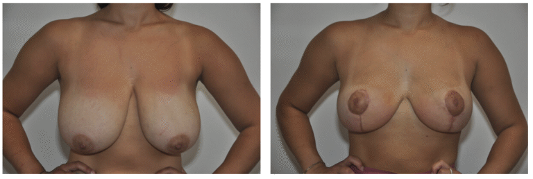 Side-by-side images of Patient 12’s chest before (left) and after (right) Breast Reduction, highlighting changes in breast size, shape, and nipple position.