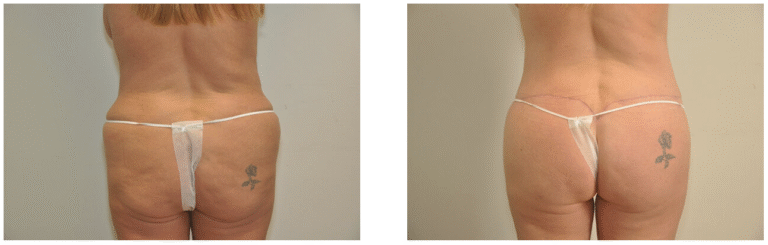 Before and after photos of Patient 6’s lower back and buttocks reveal enhanced contour following a Buttock Lift; a rose tattoo remains visible in both images.