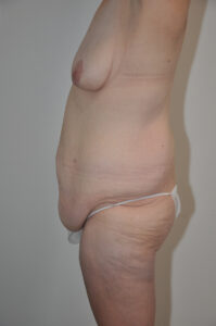 Side view of an adult person's torso showing loose skin and abdominal protrusion, with minimal clothing and a visible breast.