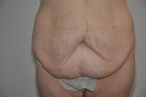 A person with excess loose skin and stretch marks on their lower abdomen, standing against a plain background, wearing white undergarments.