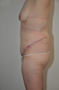 A side view of a person with a healing surgical scar across the lower abdomen and visible breast, possibly after an abdominoplasty or reconstructive surgery.