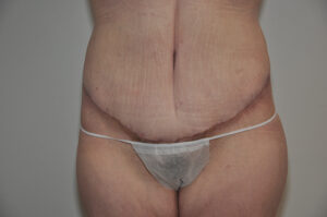 A person with visible scars and stretch marks on the abdomen, wearing a disposable undergarment, standing against a plain background.