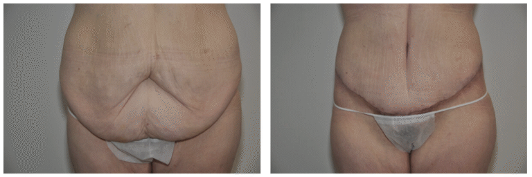 Two side-by-side photos showing the lower abdomen of a person before and after abdominoplasty, highlighting the transformation after large weight loss, with excess skin removed and a flatter appearance in the after image.