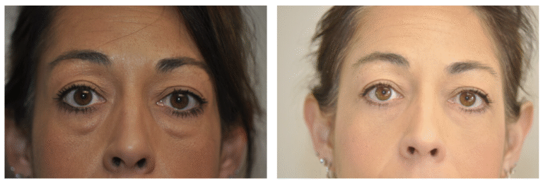 Side-by-side close-up images of a patient’s face show under-eye bags in the left image and smoother lower eyelids in the right image.