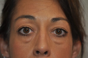 Close-up of a woman's face showing noticeable under-eye bags and makeup on her upper eyelids and lashes.