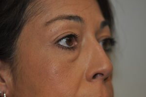 Close-up of a woman's face in partial profile, showing her eyes, nose, and cheek with visible skin texture.