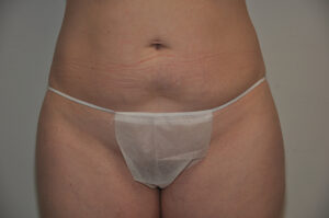 A close-up view of an adult person's lower abdomen and upper thighs, showing stretch marks and wearing a disposable undergarment.