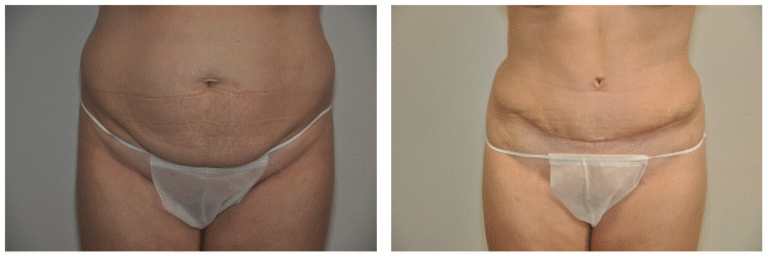 Side-by-side comparison of Patient 16’s lower abdomen before (left) and after (right) a Tummy Tuck, highlighting noticeable improvements in skin tightness and contour.