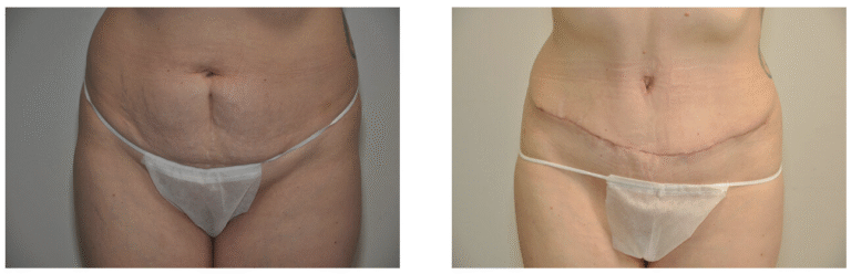 Before and after images of Patient 14’s lower abdomen highlighting changes in skin tautness and contour following a Tummy Tuck, with visible surgical scars in the after image.