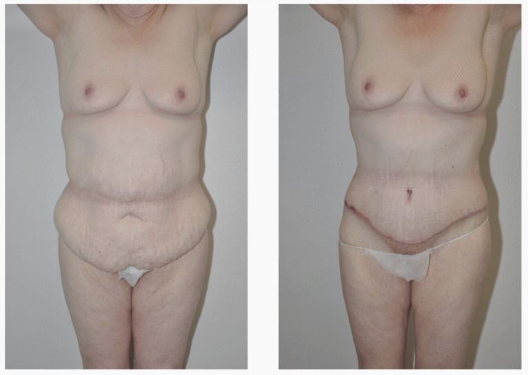 Two side-by-side photos show a front view of Patient 15 before and after her Tummy Tuck, highlighting a visible reduction in excess skin and the appearance of scarring on the abdomen in the after image.