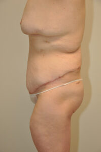 A person’s side profile shows a healing surgical scar across the lower abdomen, with visible loose skin and slight swelling.