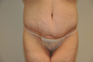 Person with loose abdominal skin and a horizontal surgical scar across the lower abdomen, wearing disposable underwear, standing against a plain background.