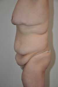 Side view of an adult person with loose abdominal skin and visible sagging in the midsection, standing against a plain background.