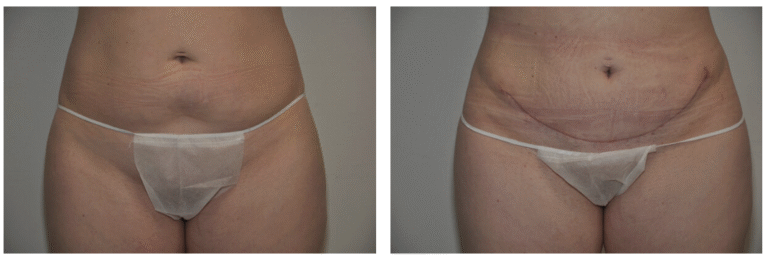 Side-by-side comparison of Patient 18's lower abdomen before and after Tummy Tuck surgery, highlighting reduced skin laxity and a visible surgical scar in the after photo.