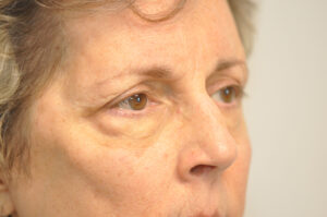 Close-up of an older person's face, focusing on the right eye and surrounding skin, showing wrinkles and natural signs of aging.