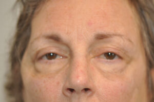 Close-up of a person's face showing the eyes, nose, and part of the forehead with visible skin texture and mild signs of aging.