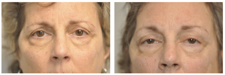 Side-by-side close-up photos of Patient 3's face show under-eye bags and puffy eyelids before (left) and noticeably reduced puffiness after (right) a cosmetic procedure.