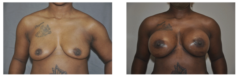 Before and after photos of Patient 26 showing the results of breast augmentation surgery; tattoos are visible on her chest and abdomen in both images.