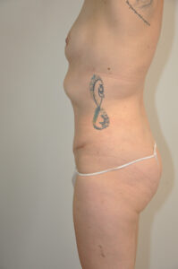 Side view of a person's torso and upper thigh, showing a tattoo on their side, with visible stretch marks and scarring on the skin.