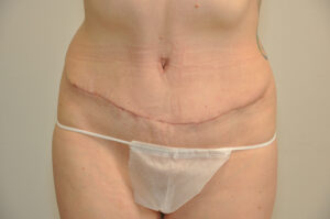 Person standing, showing abdomen with a horizontal surgical scar across the lower stomach area, wearing a disposable undergarment and no visible top.