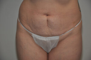 A person wearing a disposable undergarment stands against a neutral background, showing loose skin and stretch marks on the abdomen.