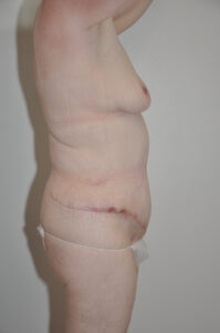 Side view of a person's torso showing a healing surgical scar across the lower abdomen, likely from an abdominoplasty or similar procedure.