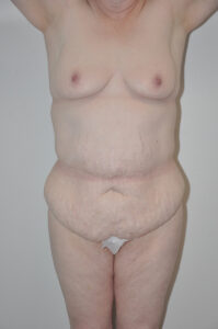 A person with excess abdominal skin and loose tissue stands facing forward with arms raised, showing the torso from neck to upper thighs against a plain background.