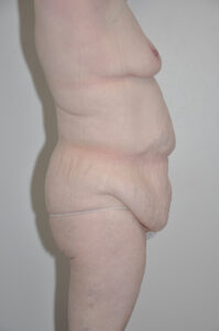 Side view of an adult person with loose, sagging abdominal skin and visible stretch marks, standing against a plain light-colored background, wearing minimal underwear.