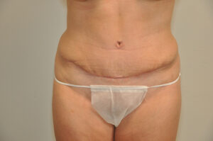 A person with a healed horizontal abdominal scar, wearing disposable underwear, is shown from the waist to mid-thigh.