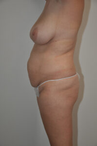 A woman standing in profile against a plain background, wearing minimal clothing, showing her torso, abdomen, and upper legs.